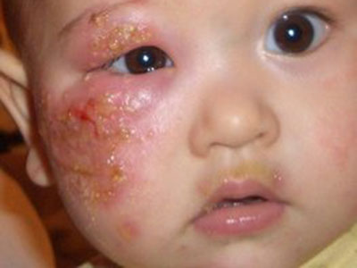 濕疹寶寶該如何正確有效的去治療