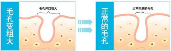 遠離毛孔粗大之——收縮毛孔的錯誤方法大揭秘