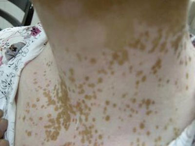 皮膚有白斑可能是哪些疾病引起的？