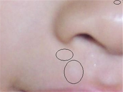 治療白癜風的食療方法