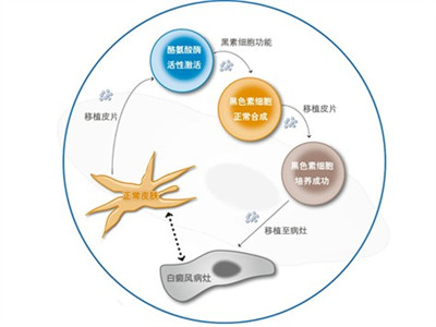 適合你的白癜風治療方法！