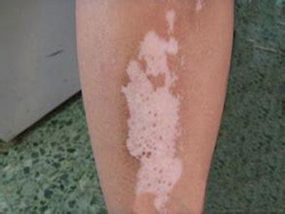 白癜風患者的皮損皮膚應如何護理？