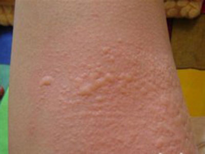 寒冷性荨麻疹的治療方法