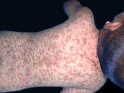 荨麻疹這種皮膚病有什麼表現