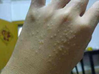 細數荨麻疹的常見症狀