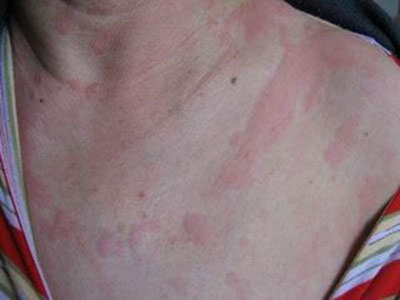 荨麻疹這種皮膚病要怎麼去預防