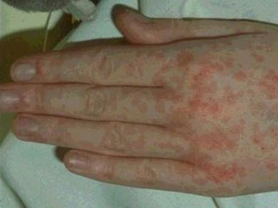 詳解荨麻疹的症狀和具體表現