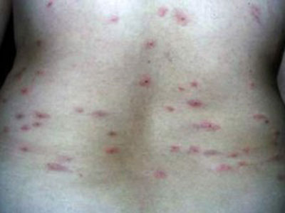 如何預防皮膚荨麻疹發病