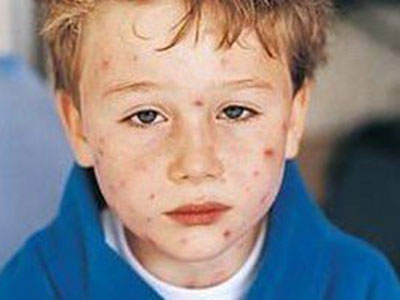 孩子身上起荨麻疹 了解症狀便以治療