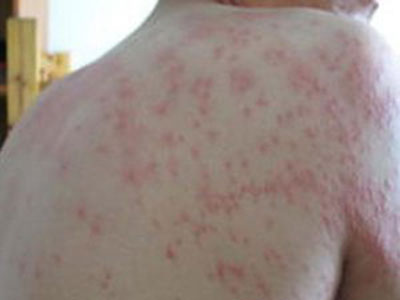 丘疹性荨麻疹有哪些注意事項