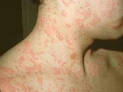 炎炎夏季裡要小心預防荨麻疹