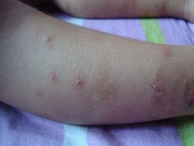 荨麻疹的預防提前知
