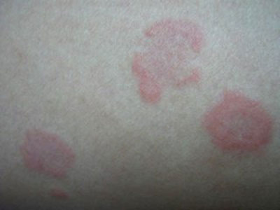 預防荨麻疹應注意的事項