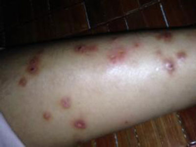 荨麻疹常見的臨床症狀表現