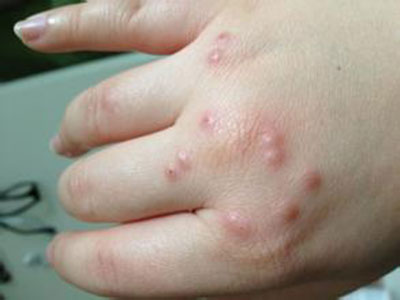 斑貼試驗可以找到荨麻疹的過敏原