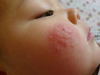 詳解過敏性荨麻疹的症狀表現