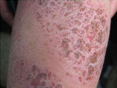 荨麻疹的主要症狀表現有哪些