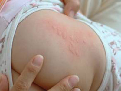 過敏性荨麻疹的症狀表現都有哪些