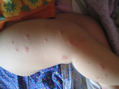荨麻疹到了晚期出現的症狀