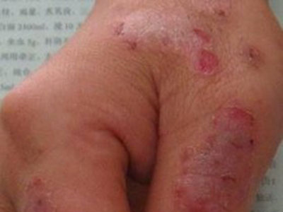 丘疹性荨麻疹的症狀是什麼