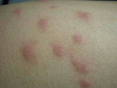 不同類型的荨麻疹都有哪些症狀