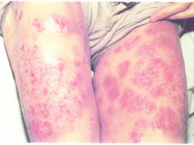 過敏性荨麻疹的症狀表現