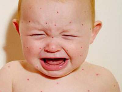 丘疹性荨麻疹的症狀都有什麼特征