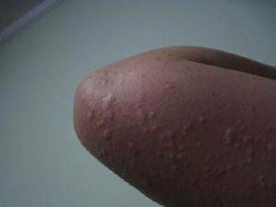 過敏性皮膚該如何預防荨麻疹