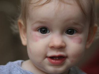 為什麼兒童會患荨麻疹？