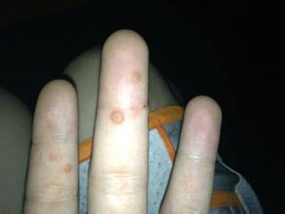 指甲脫落的原因有哪些？ 指甲脫落的3大危害。