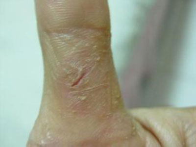 科大皮膚百科：手足癬