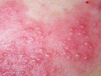 濕疹干性皮膚——9大護理技巧