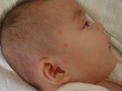 嬰兒濕疹皮損用水洗好嗎