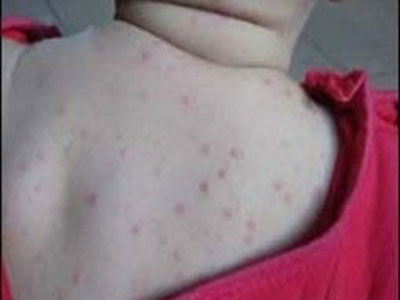嬰兒濕疹可按皮膚損害分型