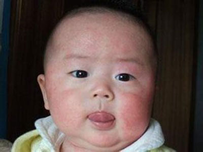 寶寶臉上有濕疹能用潤膚霜嗎