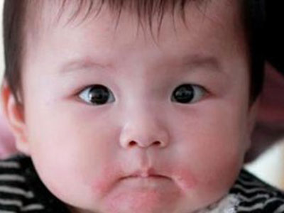 嬰幼兒為什麼會患上討厭的濕疹