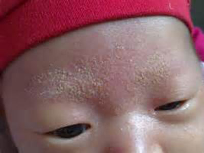 寶寶的四類濕疹需要引起注意