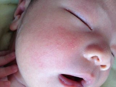 奶癬寶寶4種有效的食療小方案