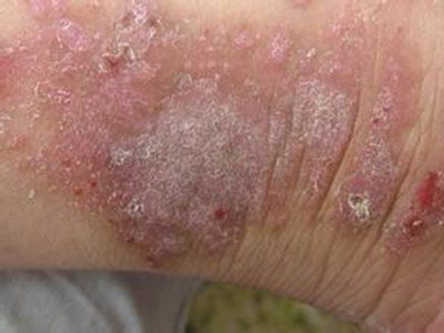 治療兒童濕疹的幾種方法