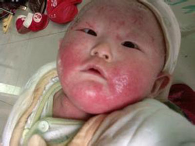 嬰兒濕疹的症狀和注意事項