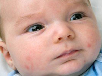 寶寶臉部濕疹不用藥能治療好嗎