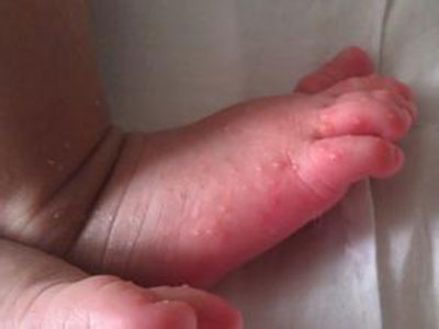 十種導致嬰兒濕疹的食物