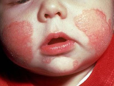 患濕疹的寶寶經常洗澡好不好