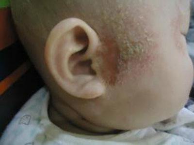 嬰兒濕疹的症狀 寶寶為什麼會患上嬰兒濕疹？