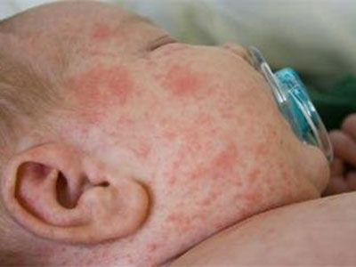 濕疹反復發作 當心孩子過敏體質