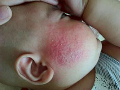 夏季濕疹易高發，防治寶寶濕疹這麼做！