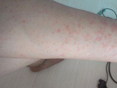 足底部濕疹有什麼壞處