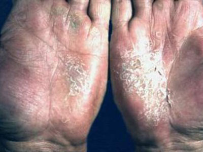 手指濕疹到底是由哪些的病因引起的
