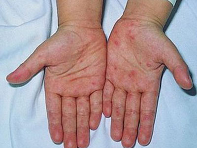 手部濕疹的護理治療