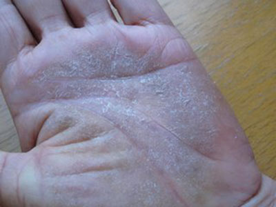 手部濕疹和手癬的診斷